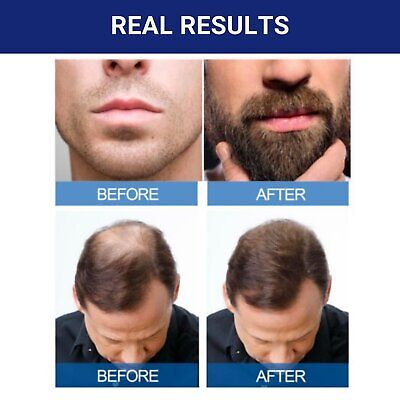 6 Months - Kirkland Generic Minoxidil 5% Mens Hair Loss Regrowth - Total 12 Oz