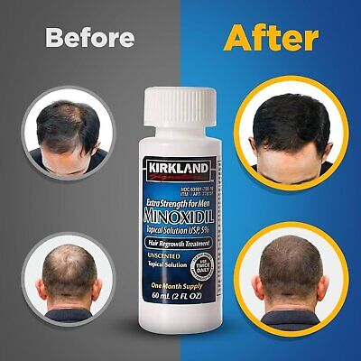 6 Months - Kirkland Generic Minoxidil 5% Mens Hair Loss Regrowth - Total 12 Oz