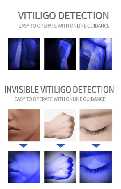 Wood's Lamp Skin Inspection Light for Professional and Personal Care Use